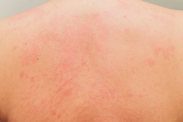 Аллергическая сыпь на теле пациента . — стоковое фото