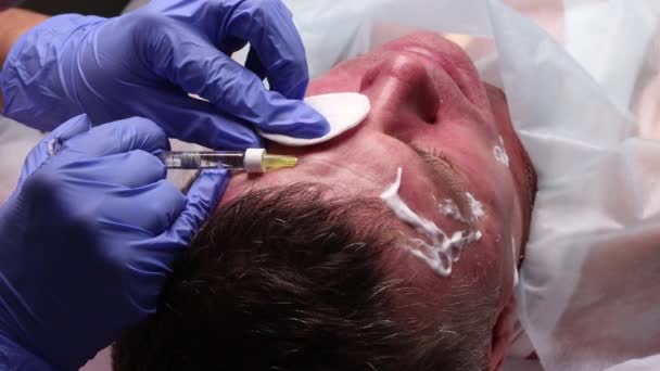 Les mains d'un chirurgien plastique dessinent des contours sur le visage des patients. pour la procédure de plastie du contour du visage . — Video