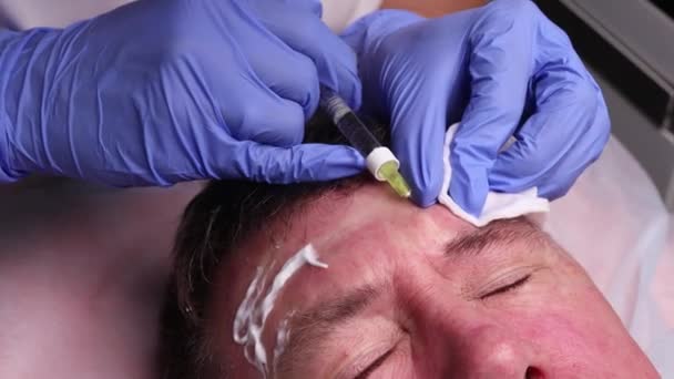 整形外科医の手は患者の顔に輪郭を描く。顔の輪郭形成の手順のために. — ストック動画