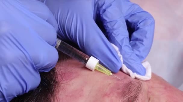 Les mains d'un chirurgien plastique dessinent des contours sur le visage des patients. pour la procédure de plastie du contour du visage . — Video