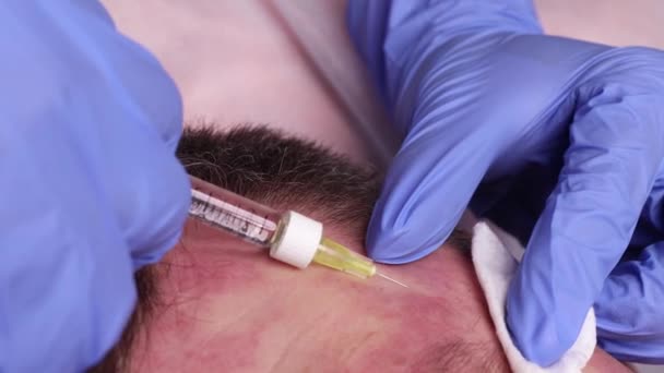 Die Hände eines plastischen Chirurgen zeichnen Konturen auf das Gesicht des Patienten. für das Verfahren der Konturplastik des Gesichts. — Stockvideo