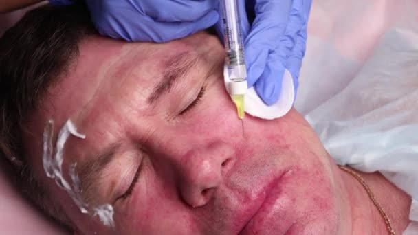 Le médecin tire un point pour les injections sur le visage des patients. préparation à la biorevitalisation en gros plan . — Video