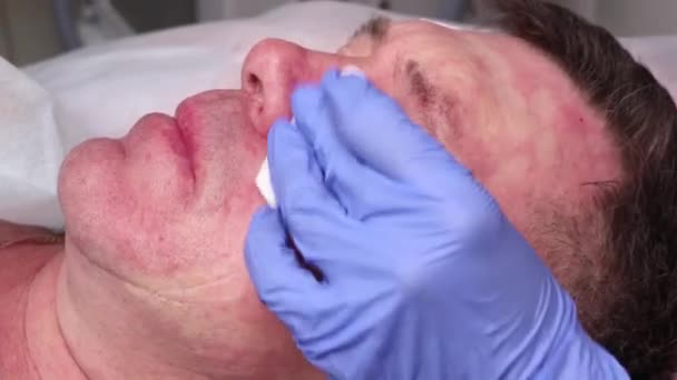 De arts tekent een punt voor injecties op het gezicht van de patiënt. voorbereiding op biorevitalisatie close-up. — Stockvideo
