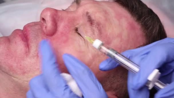 Le médecin tire un point pour les injections sur le visage des patients. préparation à la biorevitalisation en gros plan . — Video