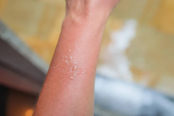 Image of burn or blister in wrist. Left hand. Hand of a woman. Image for medical purposes. — Stock Photo, Image