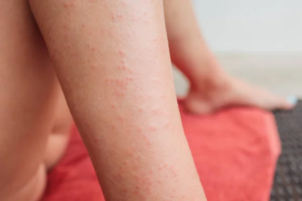 Сыпь на коже от дерматита Herpetiformis у женщины с нецелиакией чувствительностью к глютену. Сывороточные антитела положительны на пшеницу и глютен. Колоноскопия и верхняя эндоскопия отрицательны на целиакию . — стоковое фото