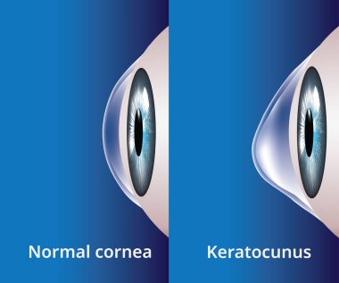 Eye cornea and keratoconus, eye disorder, medical vector clipart