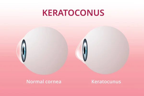 Глазная роговица и кератоконус, нарушение зрения, медицинский вектор — стоковый вектор