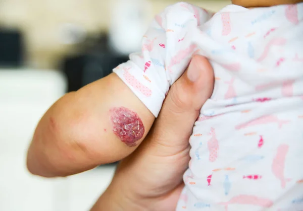 Красные родимые пятна на руке малыша — стоковое фото