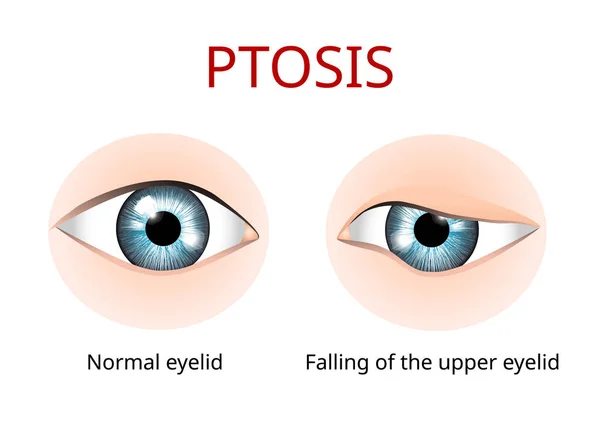 Ptosis del párpado, anatomía de la enfermedad ocular, anatomía de la enfermedad ocular, vector — Archivo Imágenes Vectoriales