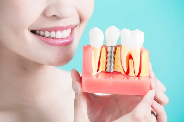 Mujer sosteniendo implante dental — Foto de Stock