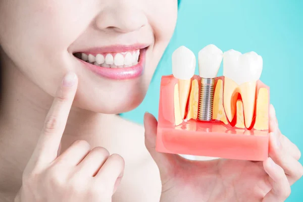 Kobieta trzyma modelu implantu zęba — Zdjęcie stockowe