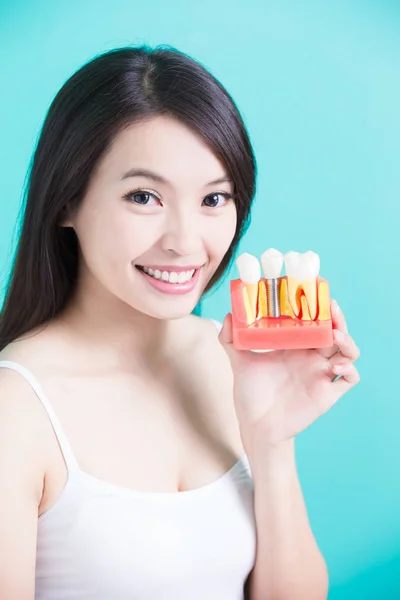 Mujer sosteniendo modelo de implante dental — Foto de Stock