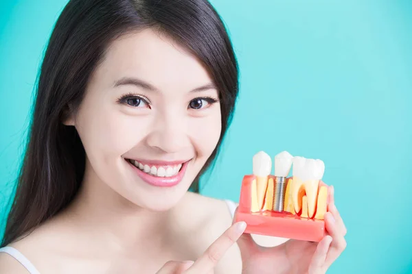 Mujer con modelo de implante dental —  Fotos de Stock