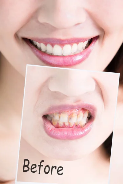 Concepto de blanquear dientes —  Fotos de Stock