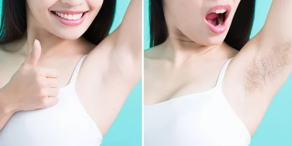 Beauty woman with under armpit problem — Stock Photo, Image