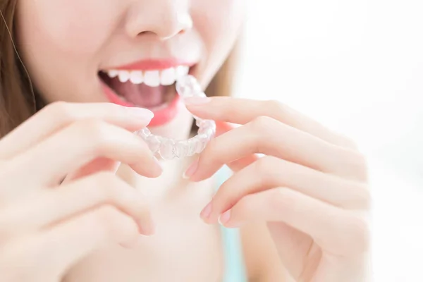 Woman with  invisible braces — Stock Photo, Image