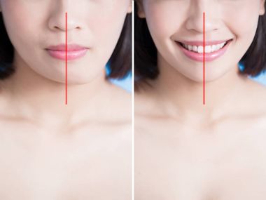 surgery of chin asymmetry  clipart