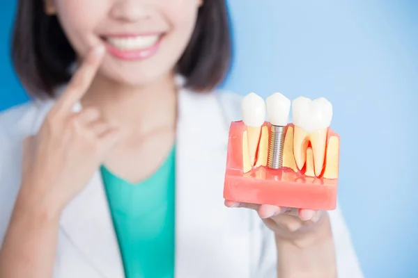 Dentista com modelo de implante dentário — Fotografia de Stock