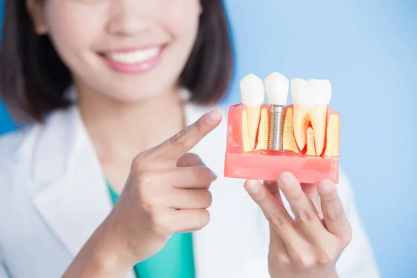 Dentista con modelo de diente de implante — Foto de Stock