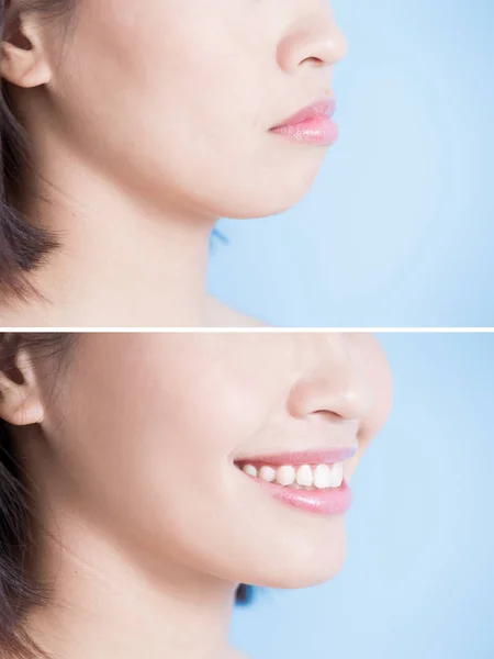 Woman with surgery of  tip chin — Stock Photo, Image