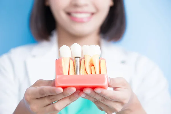 Dentista com modelo de implante dentário — Fotografia de Stock