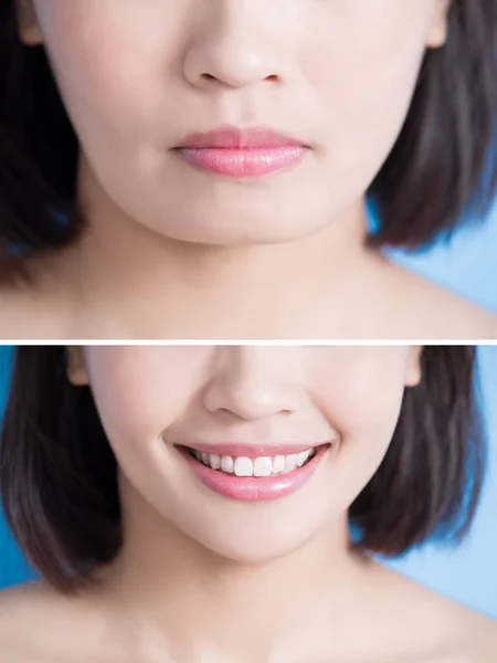 Woman with surgery of  tip chin — Stock Photo, Image