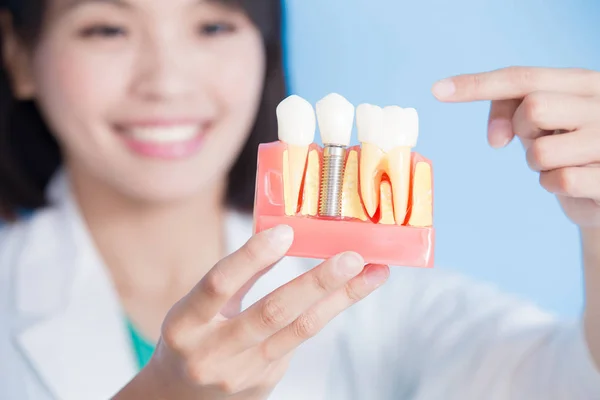 Dentista mulher com dente de implante — Fotografia de Stock