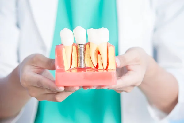 Dentista mulher com dente de implante — Fotografia de Stock