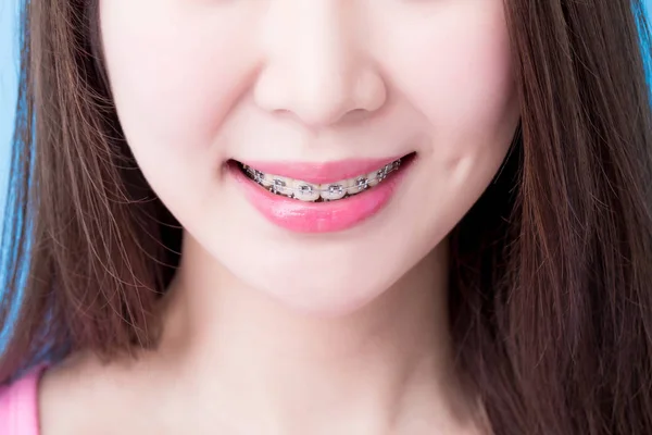 Diş Telleri Için Sağlık Kavramı Giyen Kadın Yakın Çekim — Stok fotoğraf