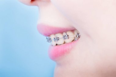 close up of woman wearing braces for your health concept clipart