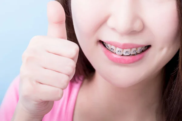 Woman Wearing Braces Showing Thumb Blue Background — Stock Photo, Image