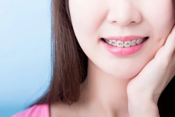 Primo Piano Della Donna Che Indossa Apparecchio Concetto Salute — Foto Stock