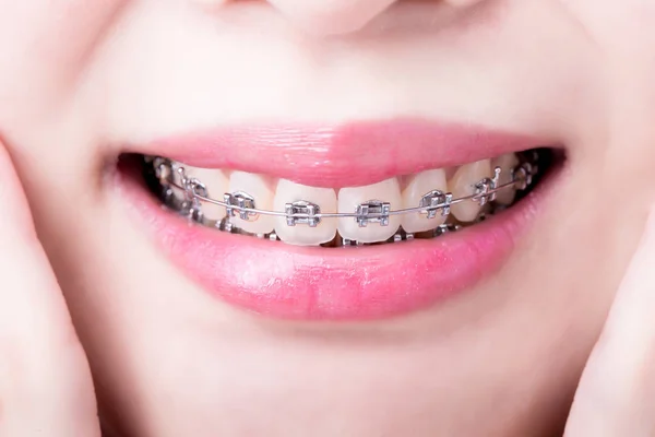 Asyalı Kadın Diş Teli Takmış Yakın Çekim — Stok fotoğraf