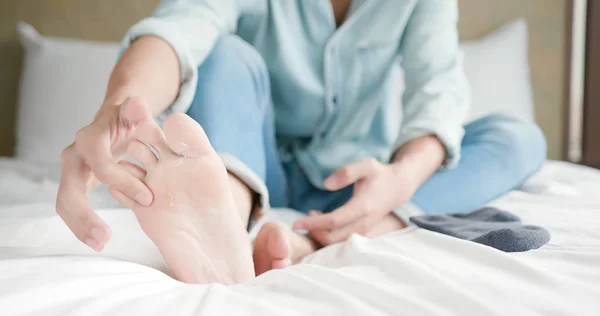 Applying cream for athletes foot — Stock Photo, Image