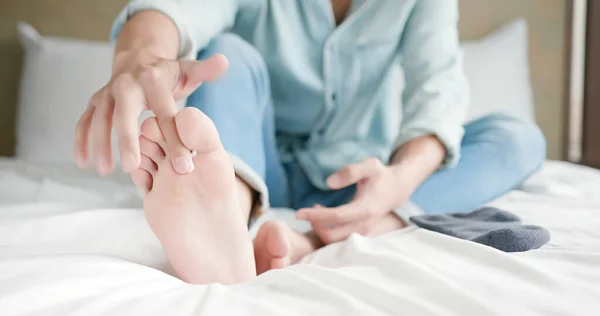 Man Applying Cream Athletes Foot Treatment — Stock Photo, Image