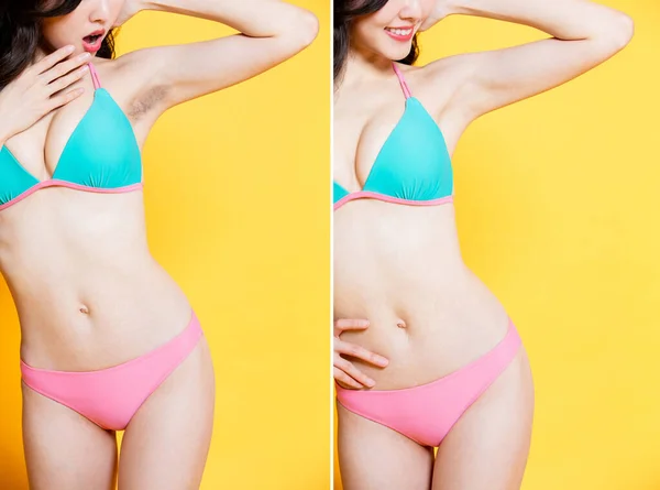 Mujer Asia Belleza Desgaste Bikini Con Problema Depilación Axila Antes —  Fotos de Stock