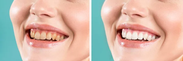 Close-up of a smiling woman before and after teeth whitening. Yellow, dark teeth. White, bright teeth. Medical procedure. Dentistry, dental health care.