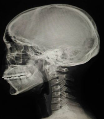 Servikal Omurga, x-ışını boyun