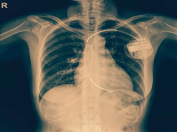 Груди рентген — стокове фото