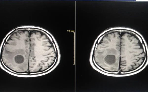 Cérebro Imagem Mostrando Massa Tumor Cérebro — Fotografia de Stock