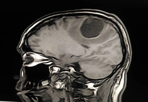 Mri Brain Visar Tumör Eller Massa Hjärnan — Stockfoto