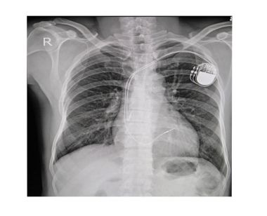 x-ışını görüntüsünü kalıcı kalp pili implantı göğüs bedeninde