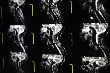 MRI boyun, boyun, görüntü 6view gösteri Serviks boyun çıkığı.