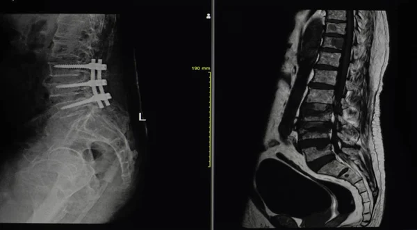 Radiografía Suave Borrosa Columna Vertebral Post Fractura Compresión Fija Cuerpo — Foto de Stock