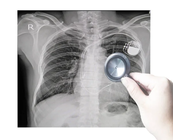 Close up hand doctor on chest x-ray image of permanent pacemaker implant in body chest.