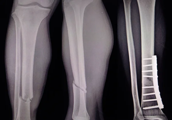 X-ray leg 3 view showing fracture with post operation internal fixation.too soft and blurry focus image.