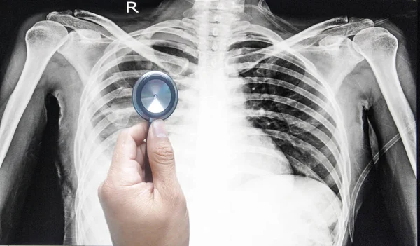 Médico Mano Sosteniendo Estetoscopio Apuntando Paciente Radiografía Tórax Antes Del — Foto de Stock