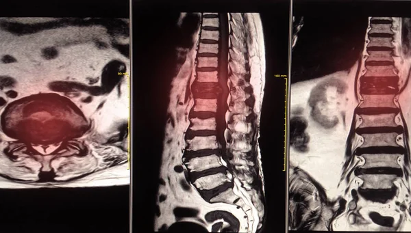 Mri Brustwirbelsäule Brustwirbelsäule Zeigt Metastasen Und Komprimiert Rückenmark — Stockfoto