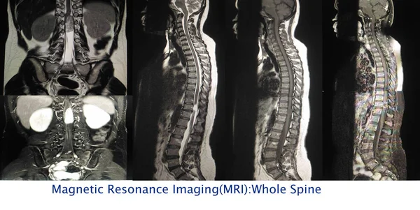 Close up MRI Whole spine A Human Show multiple images intradural extramedullary mass at Lt lateral to spinal cord at T11 level and cause cord compression.too soft and blurry image.